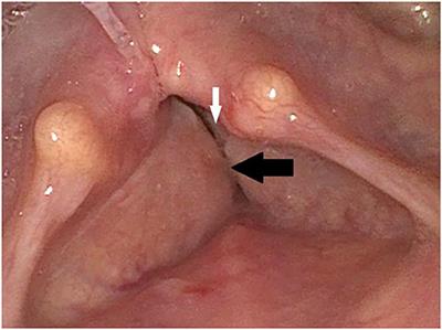 Case Report: Bilateral Palsy of the Vocal Cords After COVID-19 Infection